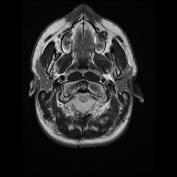 File:Chiasmatic-hypothalamic juvenile pilocytic astrocytoma (Radiopaedia 78533-91235 Axial T2 3).jpg