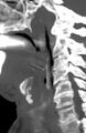 Chicken bone (fibula) perforation of the pharynx (Radiopaedia 21332-21261 A 1).jpg