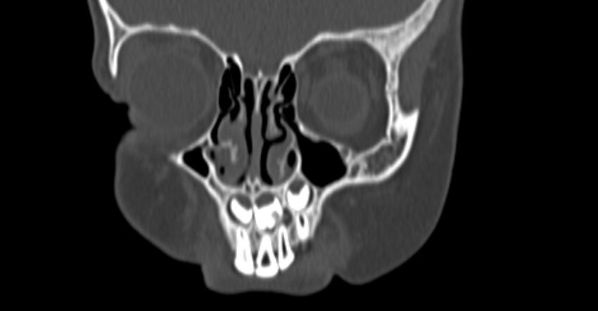 Choanal atresia (Radiopaedia 51295-56972 Coronal bone window 12).jpg