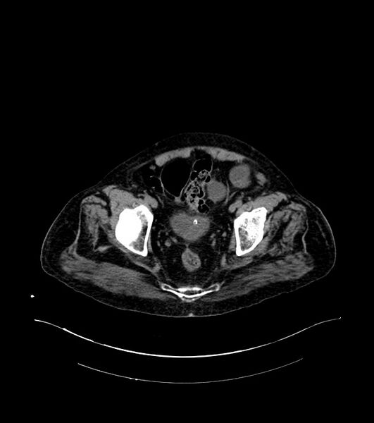 File:Cholangiocarcinoma with cerebral metastases (Radiopaedia 83519-98629 Axial non-contrast 112).jpg