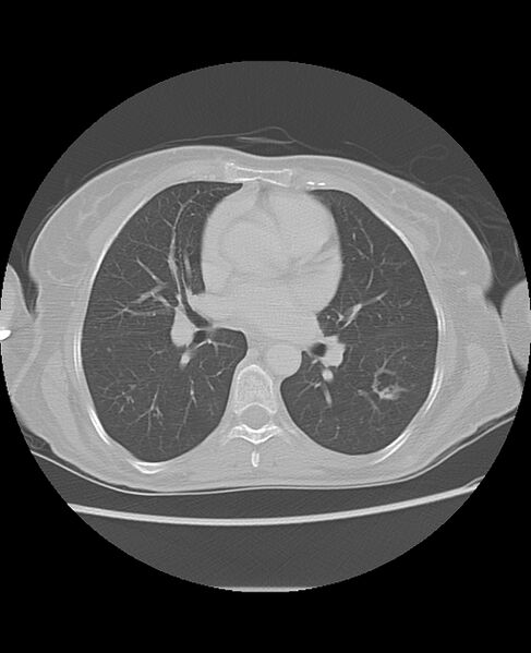 File:Chondrosarcoma (Radiopaedia 79427-92532 Axial lung window 29).jpg