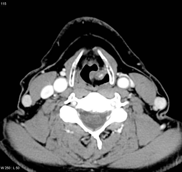 File:Chondrosarcoma - larynx (Radiopaedia 4588-6698 A 2).jpg