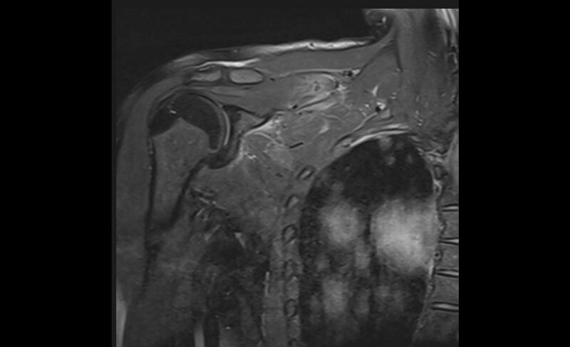File:Choriocarcinoma in the shoulder (Radiopaedia 28603-28861 Coronal PD FS 10).jpg