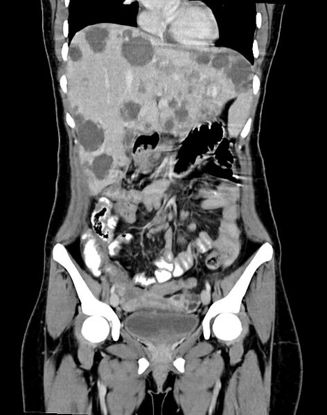 File:Choriocarcinoma liver metastases (Radiopaedia 74768-85766 B 44).jpg