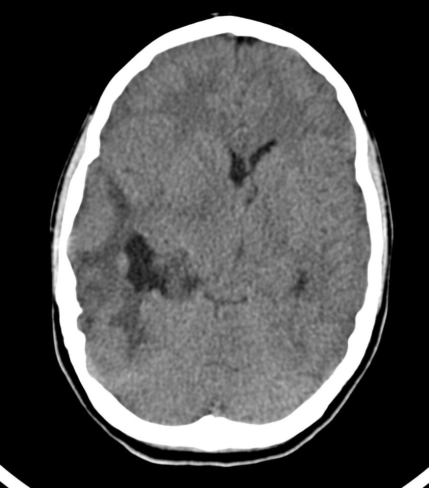 Choroid plexus carcinoma (Radiopaedia 91013-108552 Axial non-contrast 27).jpg