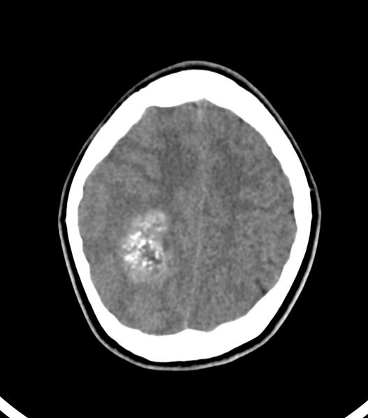 File:Choroid plexus carcinoma (Radiopaedia 91013-108552 Axial non-contrast 48).jpg