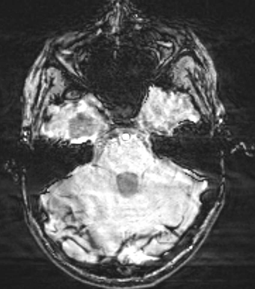 Choroid plexus carcinoma (Radiopaedia 91013-108553 Axial SWI 27).jpg