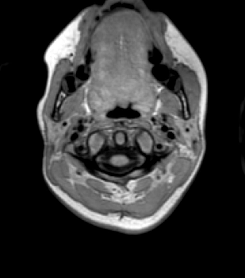Choroid plexus carcinoma (Radiopaedia 91013-108553 Axial T1 11).jpg