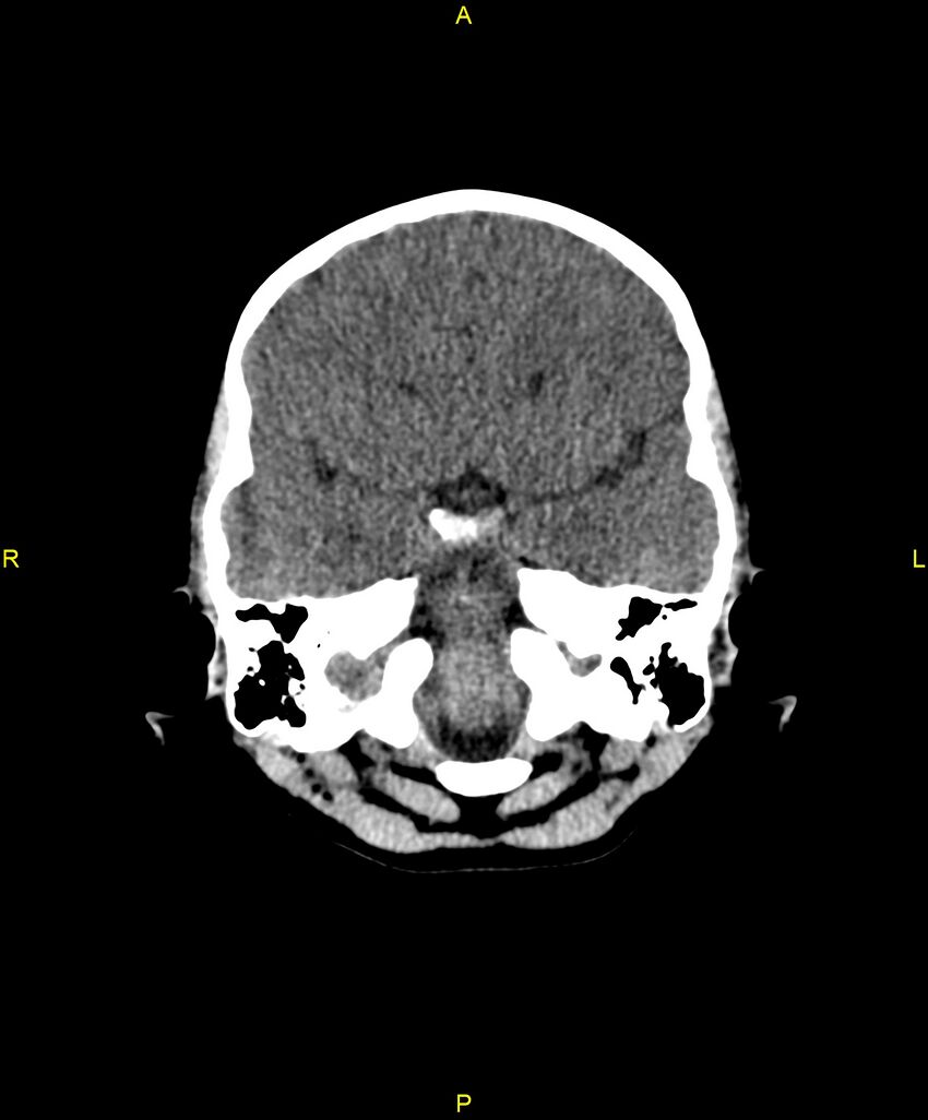 Choroidal fissure cyst (Radiopaedia 89481-106465 Axial non-contrast 39).jpg