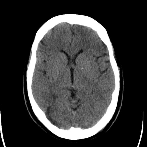 File:Chronic bilateral occipital lobe infarcts (Radiopaedia 31276-31996 Axial non-contrast 20).jpg