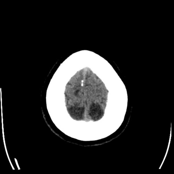 File:Chronic bilateral occipital lobe infarcts (Radiopaedia 31276-31996 Axial non-contrast 40).jpg