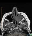 Chronic invasive fungal sinusitis with mycetoma (Radiopaedia 27430-27627 Axial T1 1).jpg