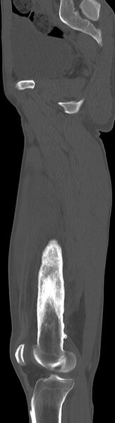 File:Chronic osteomyelitis (with sequestrum) (Radiopaedia 74813-85822 C 69).jpg