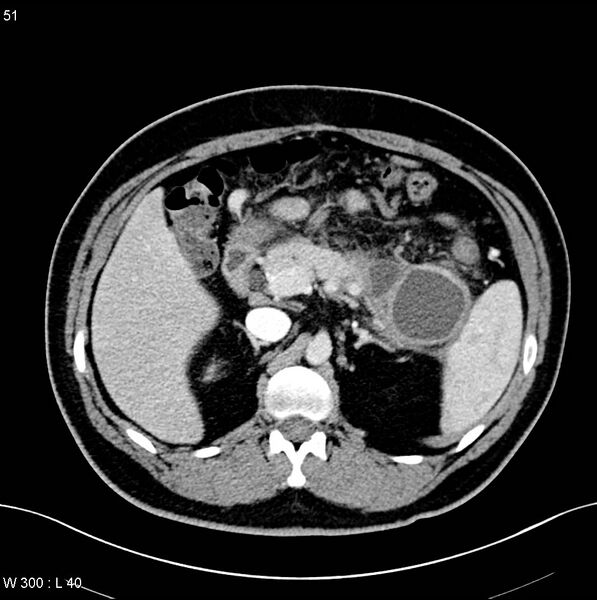 File:Chronic pancreatitis and pseudocysts (Radiopaedia 6724-7935 B 7).jpg