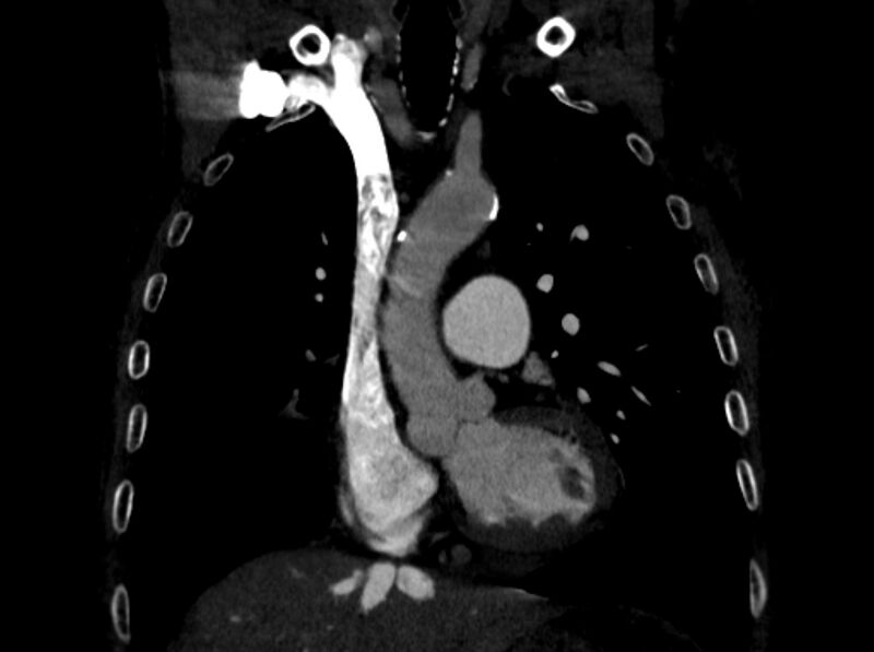 File:Chronic pulmonary embolism (Radiopaedia 91241-108843 A 40).jpg