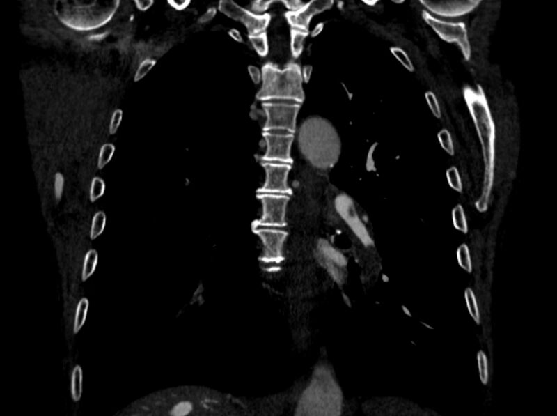 File:Chronic pulmonary embolism (Radiopaedia 91241-108843 A 72).jpg