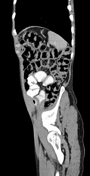 File:Chronic small bowel volvulus (Radiopaedia 75224-86322 C 31).jpg