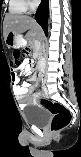 File:Chronic small bowel volvulus (Radiopaedia 75224-86322 C 78).jpg