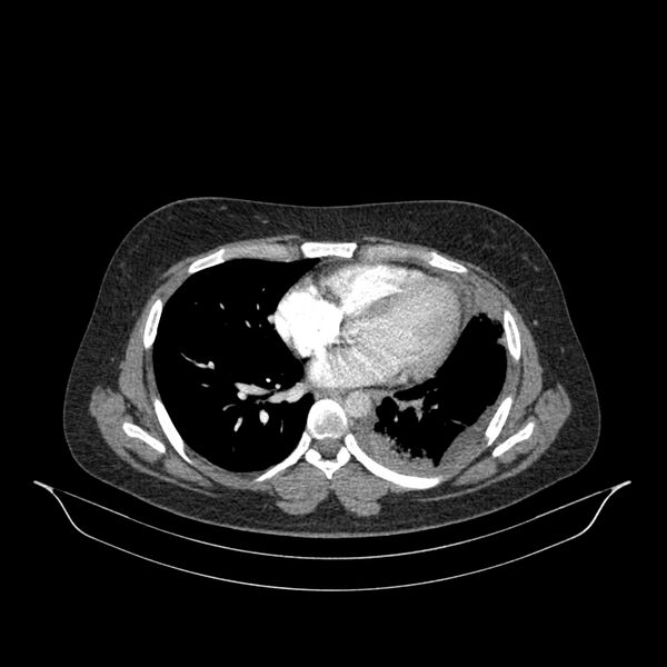 File:Chronic thromboembolic pulmonary hypertension (CTEPH) (Radiopaedia 74597-85532 Axial C+ CTPA 69).jpg