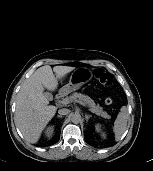 File:Clear cell renal cell carcinoma (Radiopaedia 85006-100539 Axial non-contrast 27).jpg