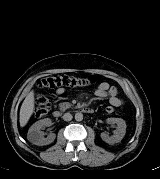 File:Clear cell renal cell carcinoma (Radiopaedia 85006-100539 Axial non-contrast 38).jpg