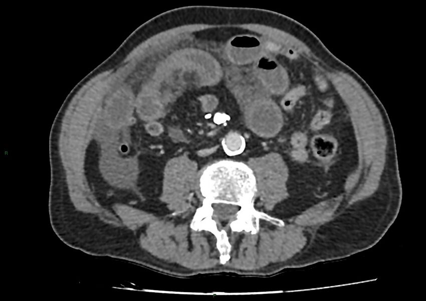 Closed loop small bowel obstruction with ischemia (Radiopaedia 84180-99456 A 67).jpg