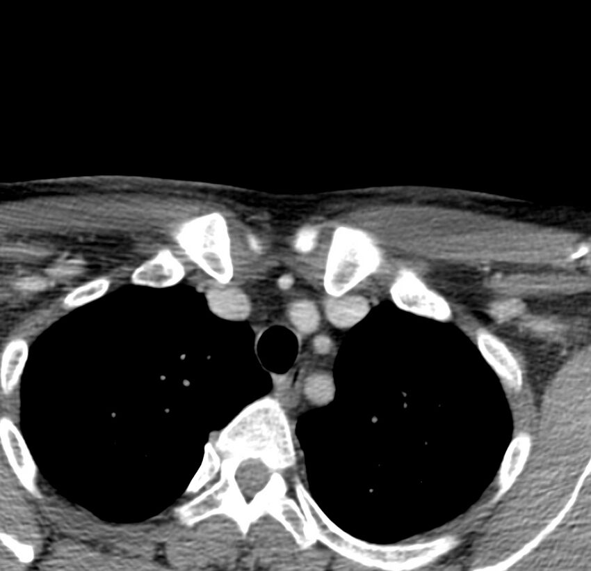 Colloid cyst of thyroid (Radiopaedia 22897-22923 Axial C+ delayed 80).jpg