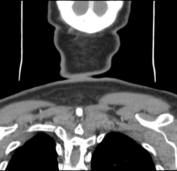 File:Colloid cyst of thyroid (Radiopaedia 22897-22923 Coronal C+ delayed 60).jpg
