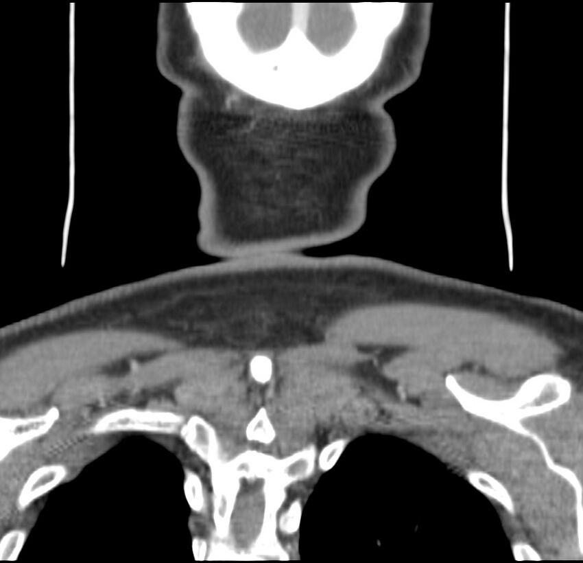 Colloid cyst of thyroid (Radiopaedia 22897-22923 Coronal C+ delayed 60).jpg