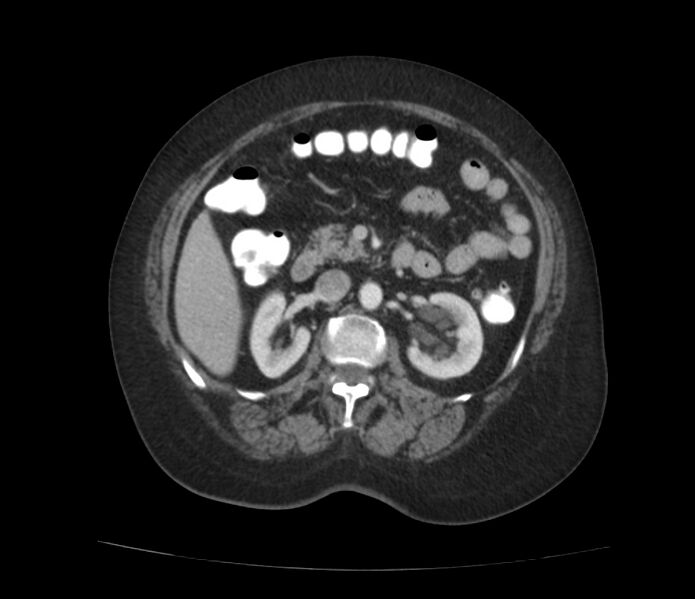 File:Colonic diverticulosis (Radiopaedia 22934-22957 A 28).jpg
