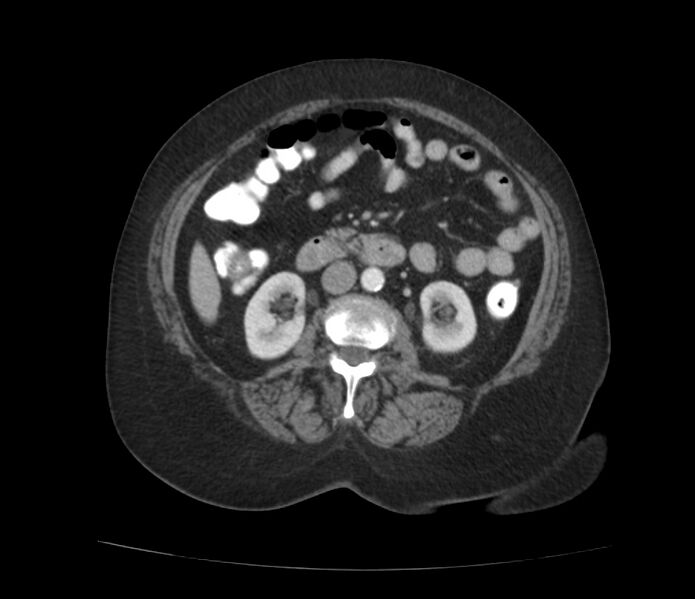 File:Colonic diverticulosis (Radiopaedia 22934-22957 A 33).jpg