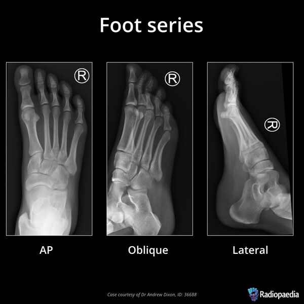 File:Foot series (Radiopaedia 68535).jpeg