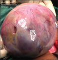 Giant mucinous cystadenocarcinoma of ovary