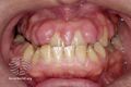 Gum hypertrophy due to ciclosporin (DermNet NZ treatments-csa-gums).jpg