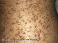 Lichen amyloidosis (DermNet NZ lichen-amyloidosis-16).jpg