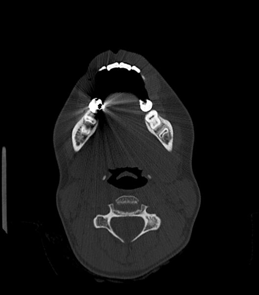 File:Nasoorbitoethmoid fracture (Radiopaedia 90044-107205 Axial bone window 32).jpg