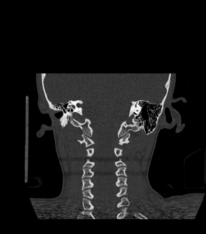 Nasoorbitoethmoid fracture (Radiopaedia 90044-107205 Coronal bone window 110).jpg