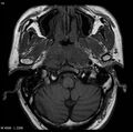 Nasopharyngeal carcinoma (Radiopaedia 4546-6667 Axial T1 8).jpg