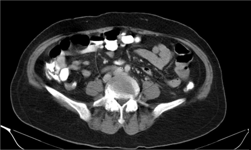 File:Necrotizing pancreatitis (Radiopaedia 20595-20495 A 28).jpg