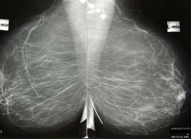 File:Needle in the breast (Radiopaedia 16871).jpg