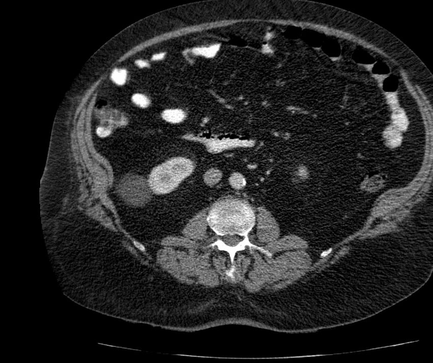 Nephroptosis with inguinal hernia containing perirenal fat (Radiopaedia 56632-63391 C 169).jpg
