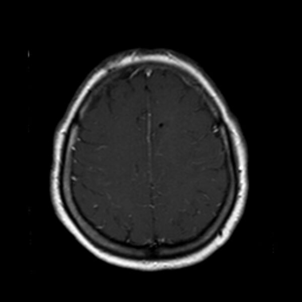 File:Neurofibromatosis type 2 (Radiopaedia 67470-76871 Axial T1 C+ 18).jpg