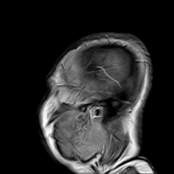 File:Neurofibromatosis type 2 (Radiopaedia 67470-76871 Sagittal T1 C+ 1).jpg