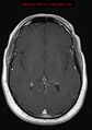 Neuroglial cyst (Radiopaedia 10713-11184 Axial T1 C+ 12).jpg