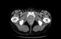 Non-puerperal uterine inversion (Radiopaedia 78343-91094 A 100).jpg