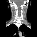 Normal CT of the neck (Radiopaedia 14575-14500 Coronal C+ 35).jpg