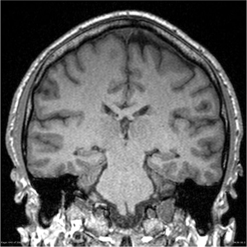 Normal brain MRI (non-focal epilepsy protocol) (Radiopaedia 38571-40700 Coronal T1 47).jpg