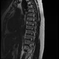 Normal cervical and thoracic spine MRI (Radiopaedia 35630-37156 G 10).png