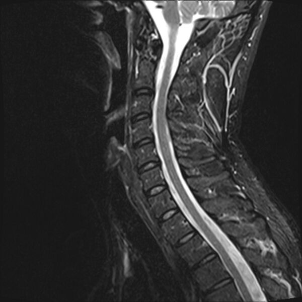 File:Normal cervical spine MRI (Radiopaedia 38418-40496 Sagittal STIR 8).jpg