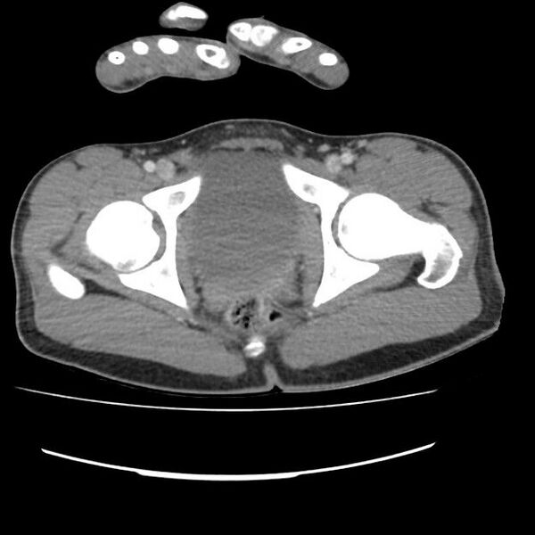 File:Normal dual-phase trauma CT chest,abdomen and pelvis (Radiopaedia 48092-52899 A 111).jpg